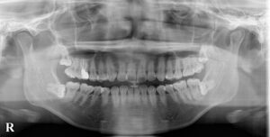 上下左右完全骨性埋伏智歯の抜歯症例